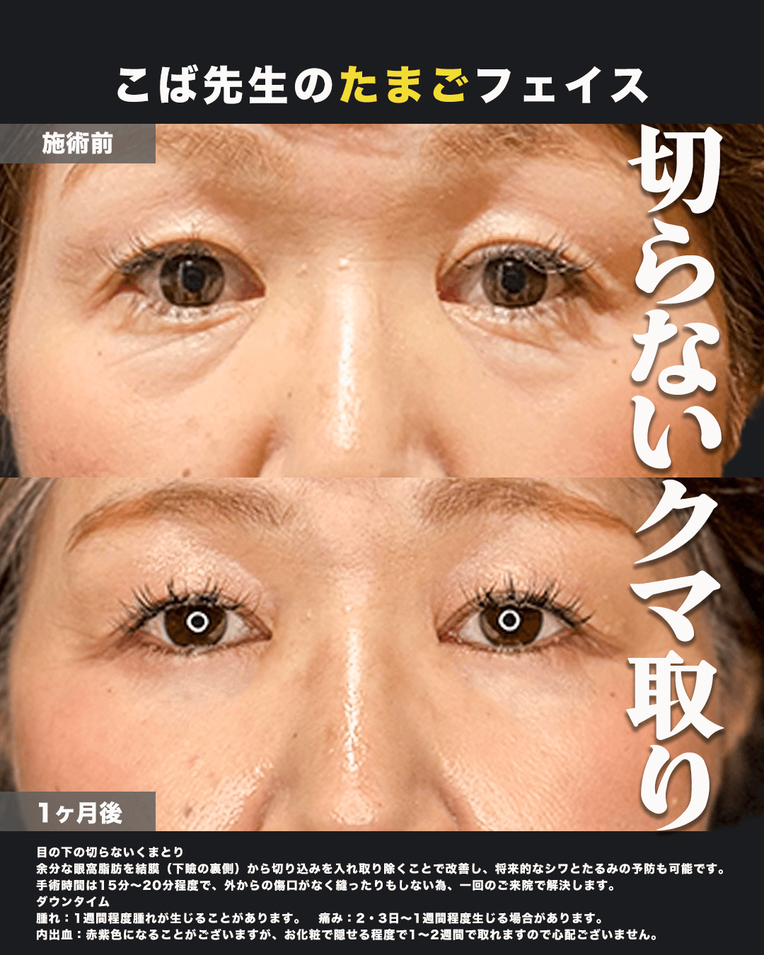 切らないクマ取り正面