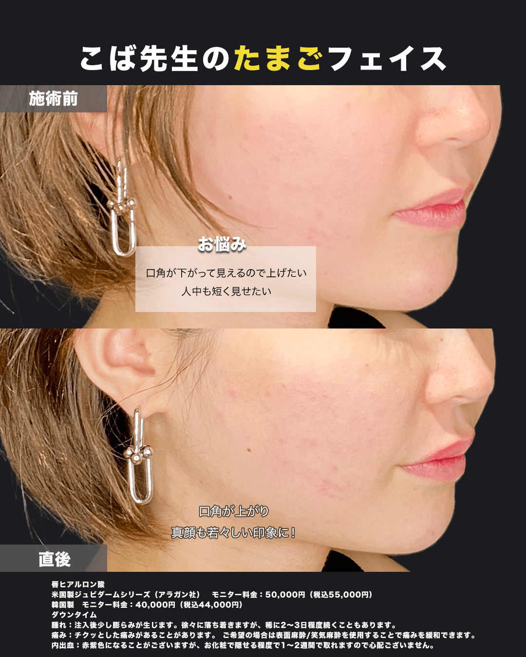 唇ヒアルロン酸注入-斜め