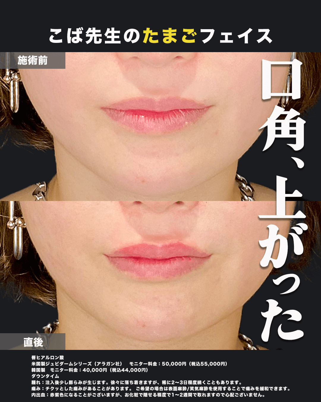 唇ヒアルロン酸注入-正面