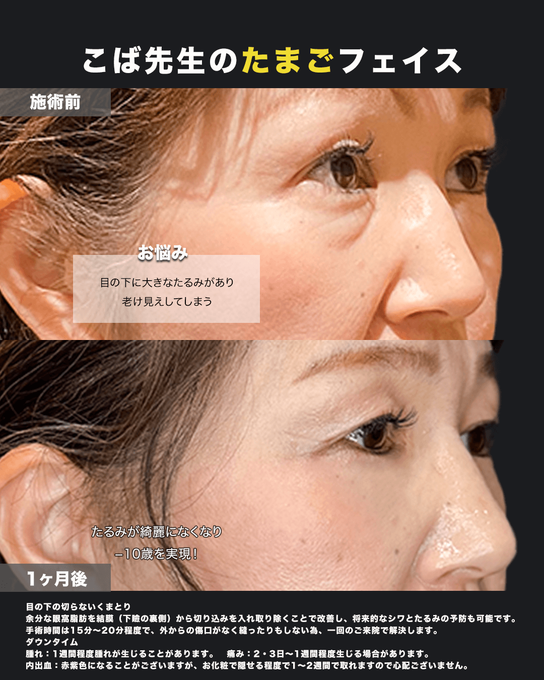 切らないクマ取り斜め