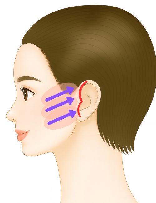 SMASフェイスリフト・エクストラロング