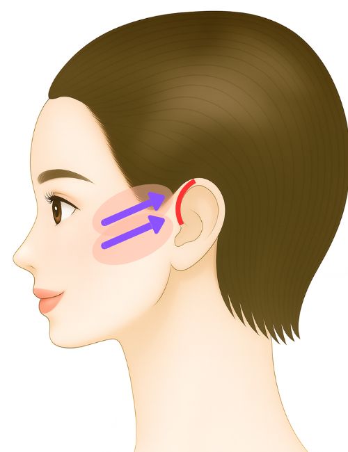 SMASフェイスリフト・ロング