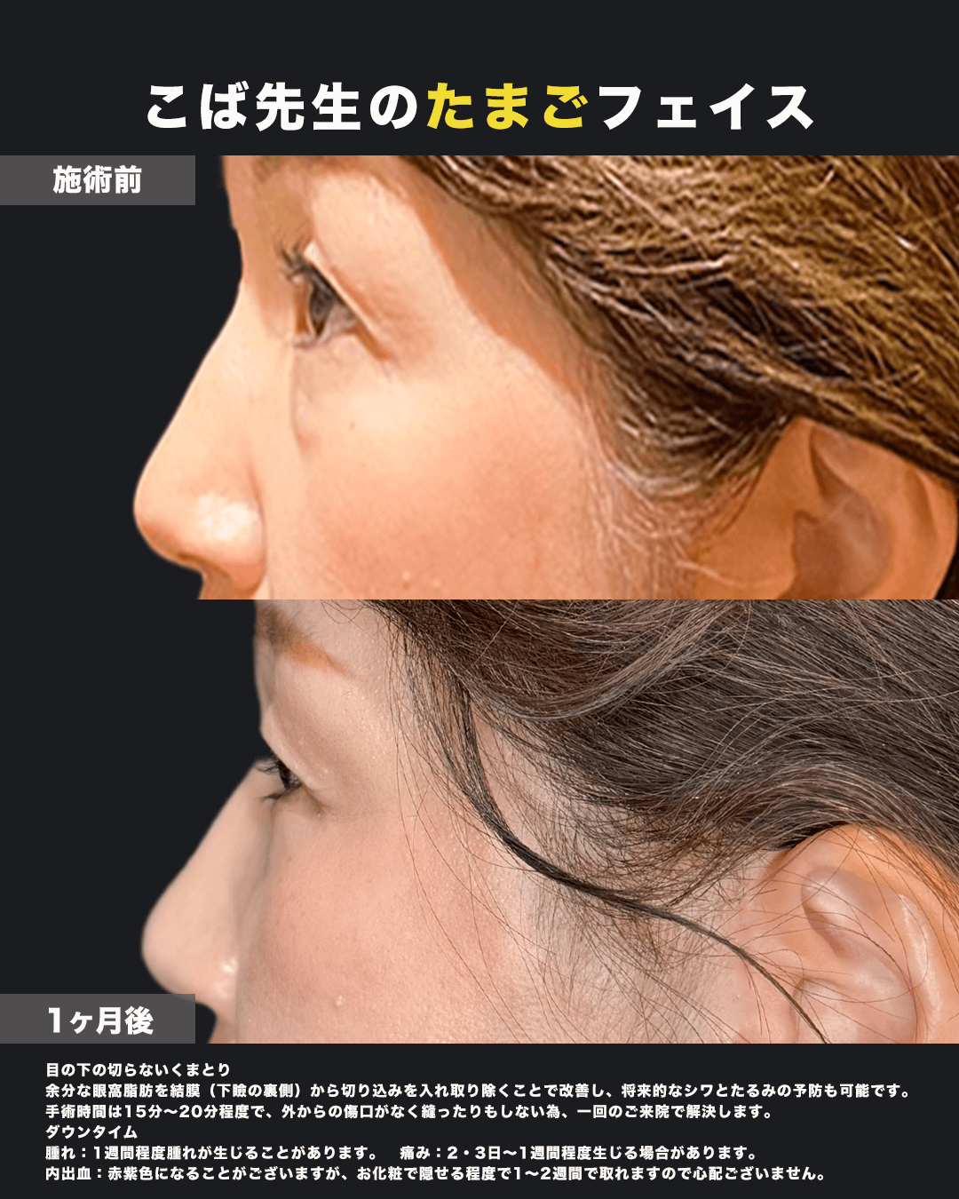 切らないクマ取り横