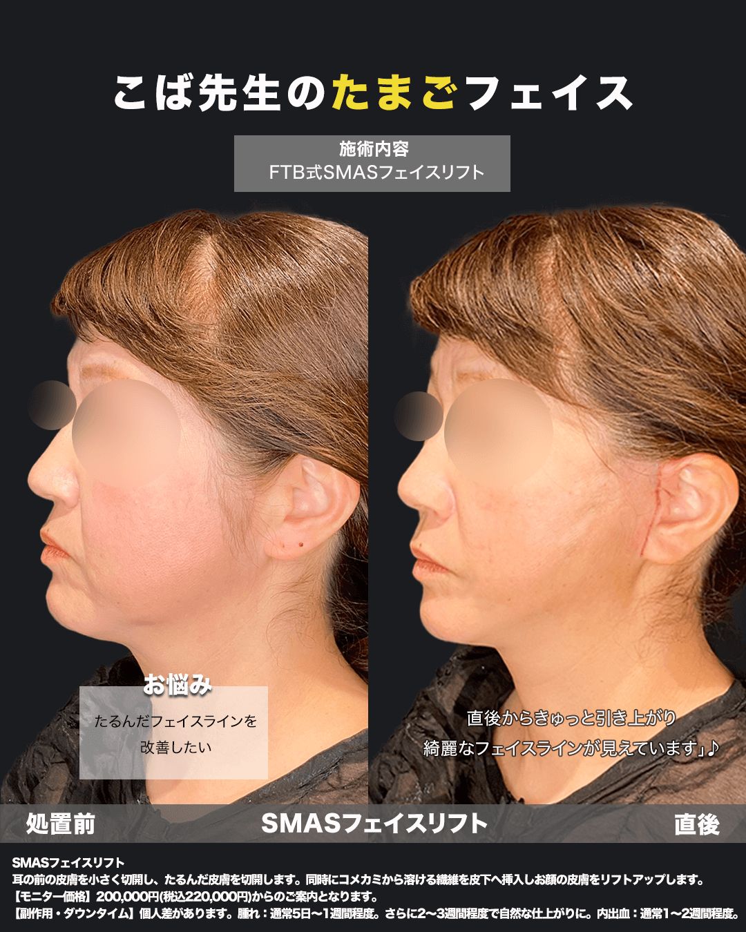 切開リフト直後5（斜め）