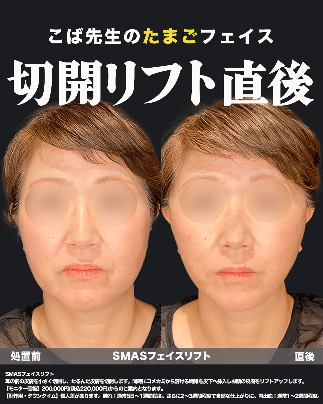 切開リフト直後5（正面）