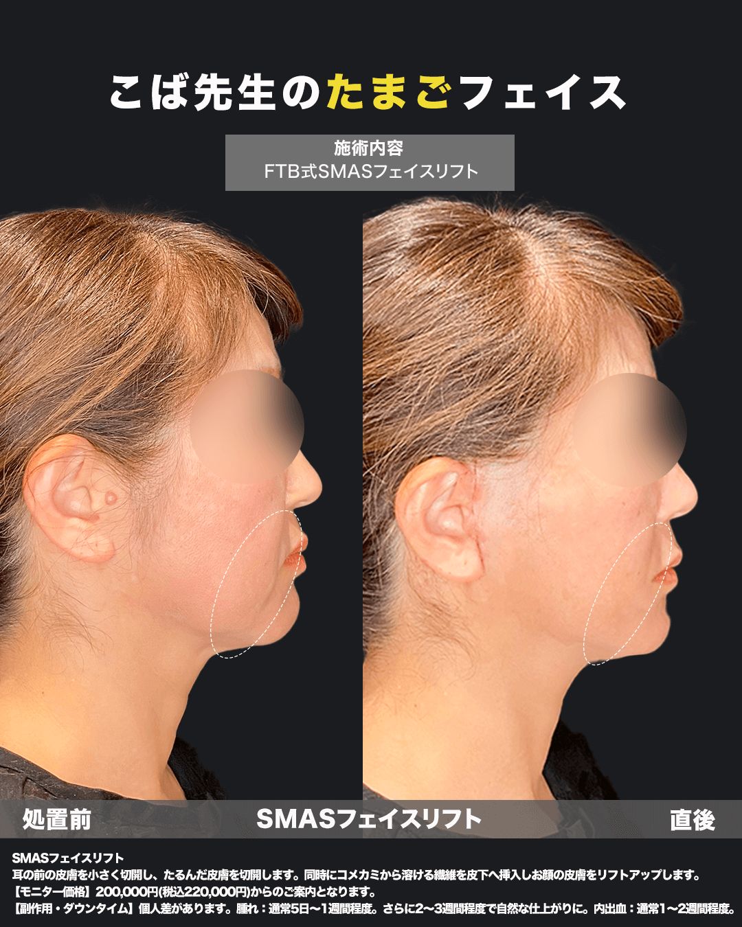 切開リフト直後5（横）