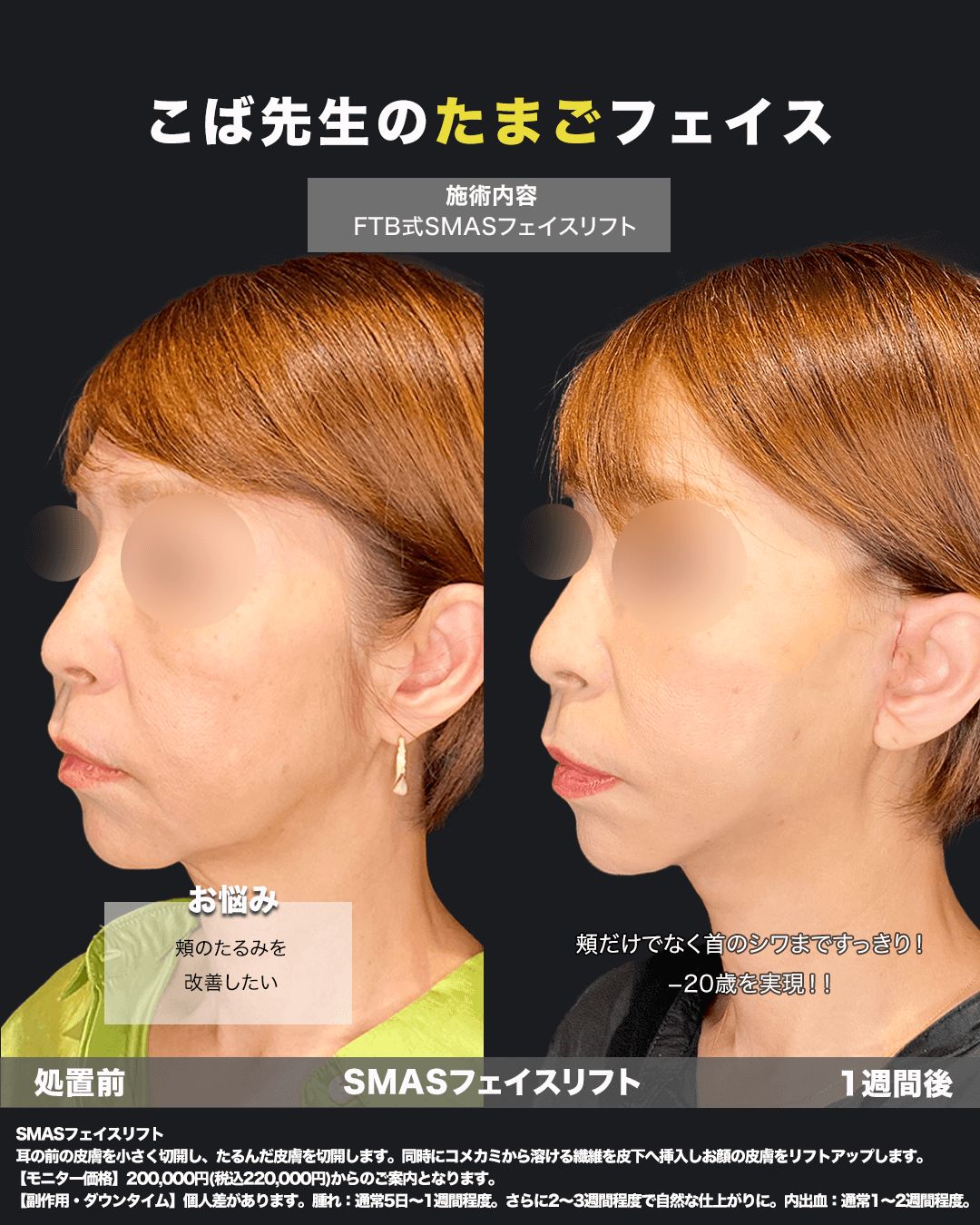 切開リフト症例7（斜め）