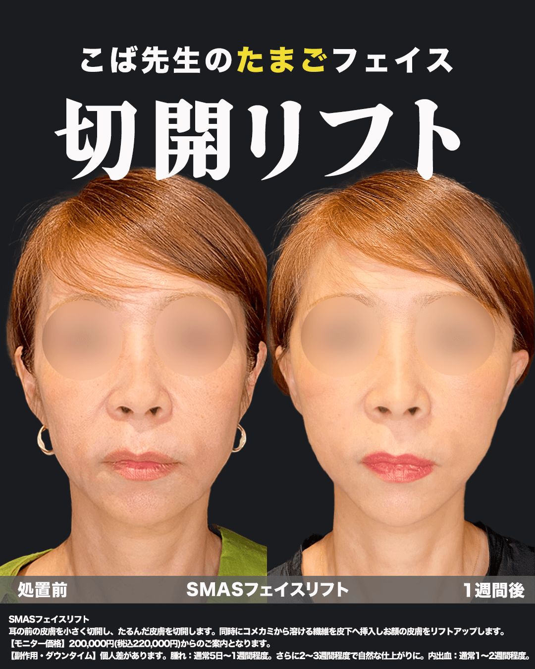 切開リフト症例7（正面）