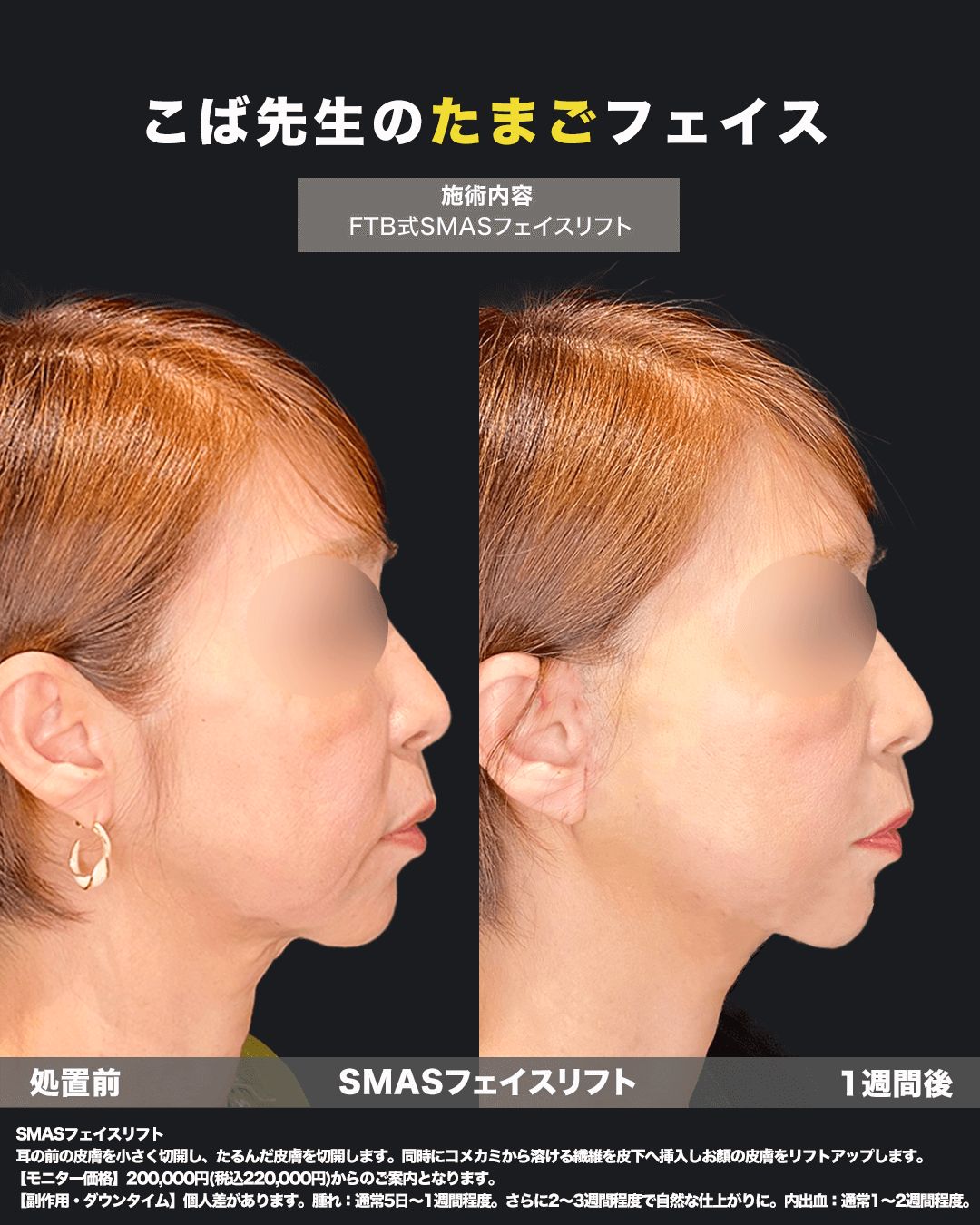 切開リフト症例7（横）