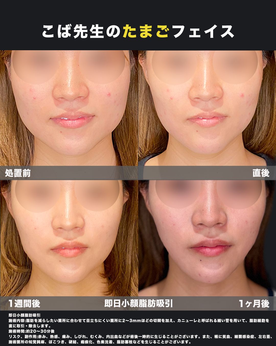 脂肪吸引の症例15（正面4つ）