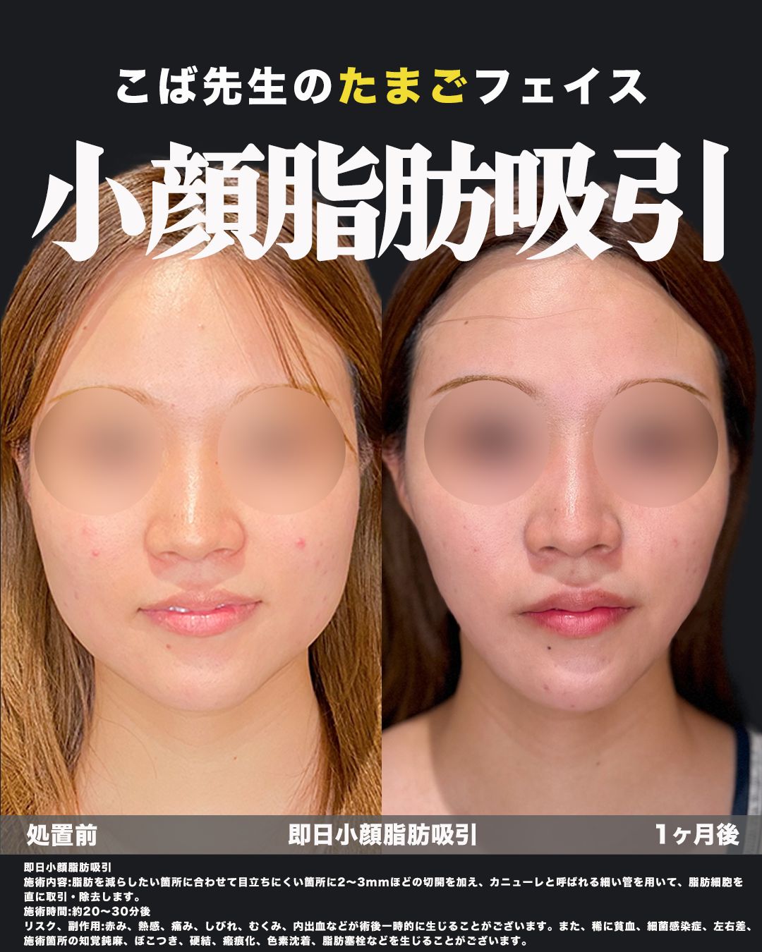 脂肪吸引の症例15（正面）