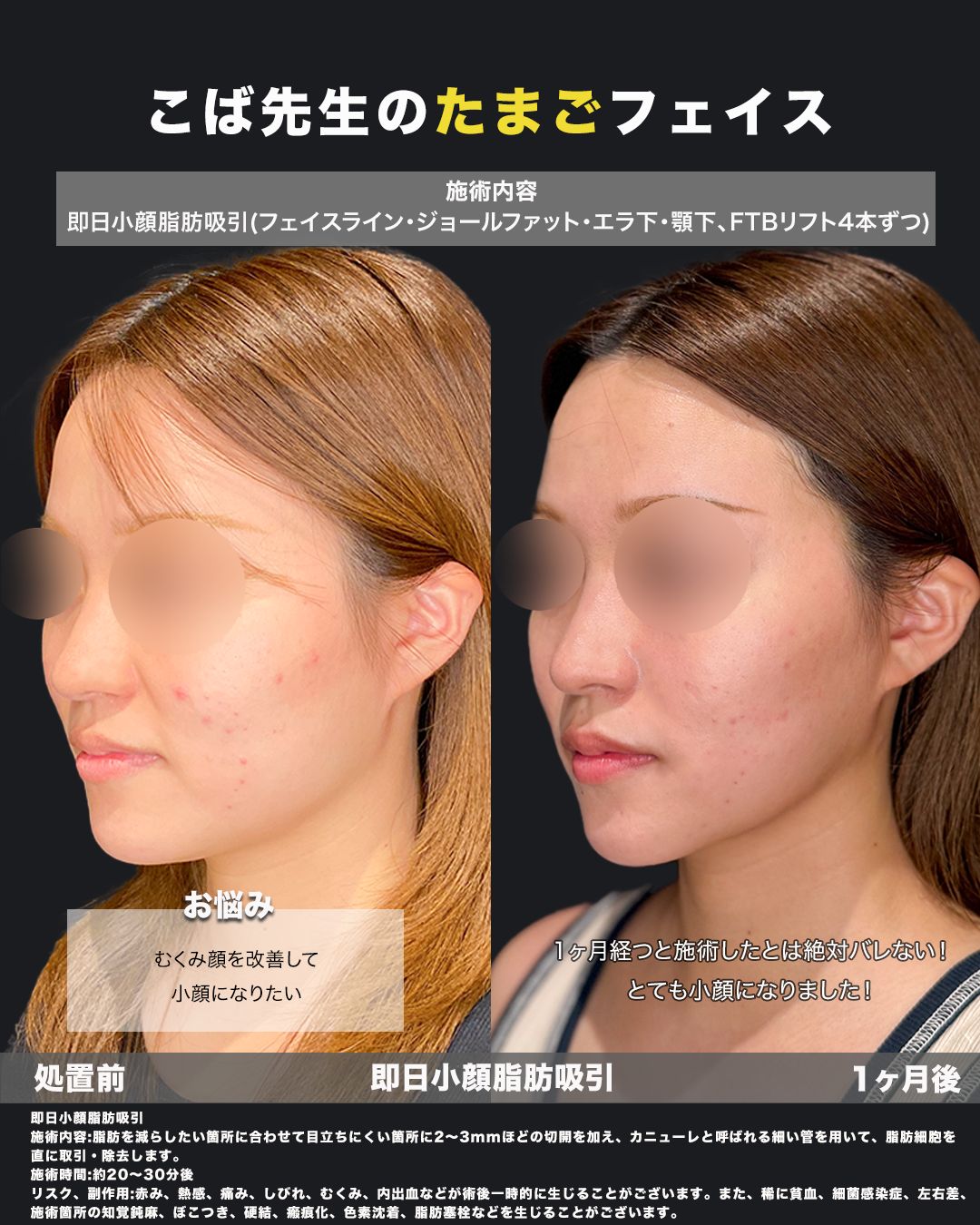 脂肪吸引の症例15（斜め）