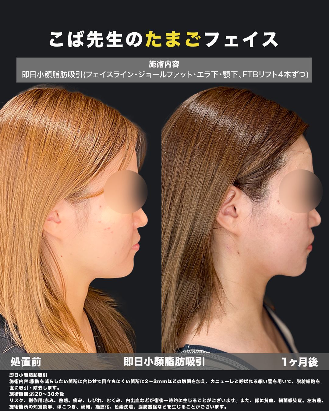 脂肪吸引の症例15（横）