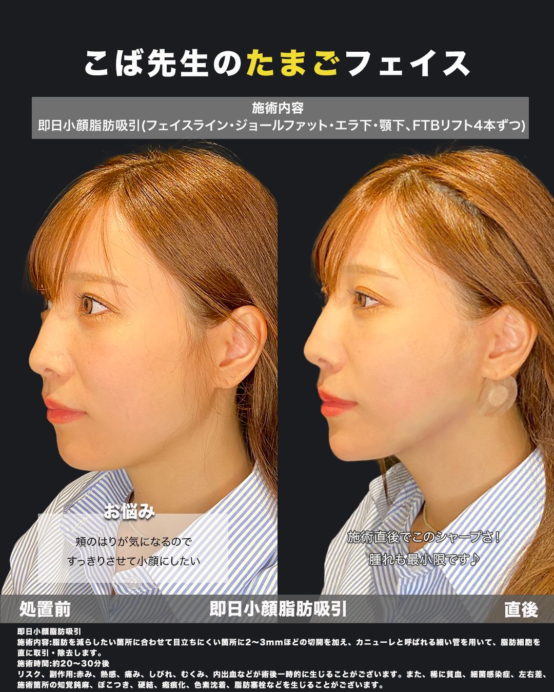 脂肪吸引症例写真（斜め）