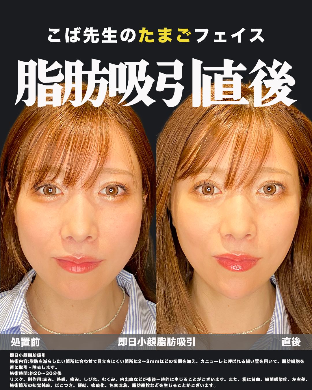 脂肪吸引症例写真（正面）