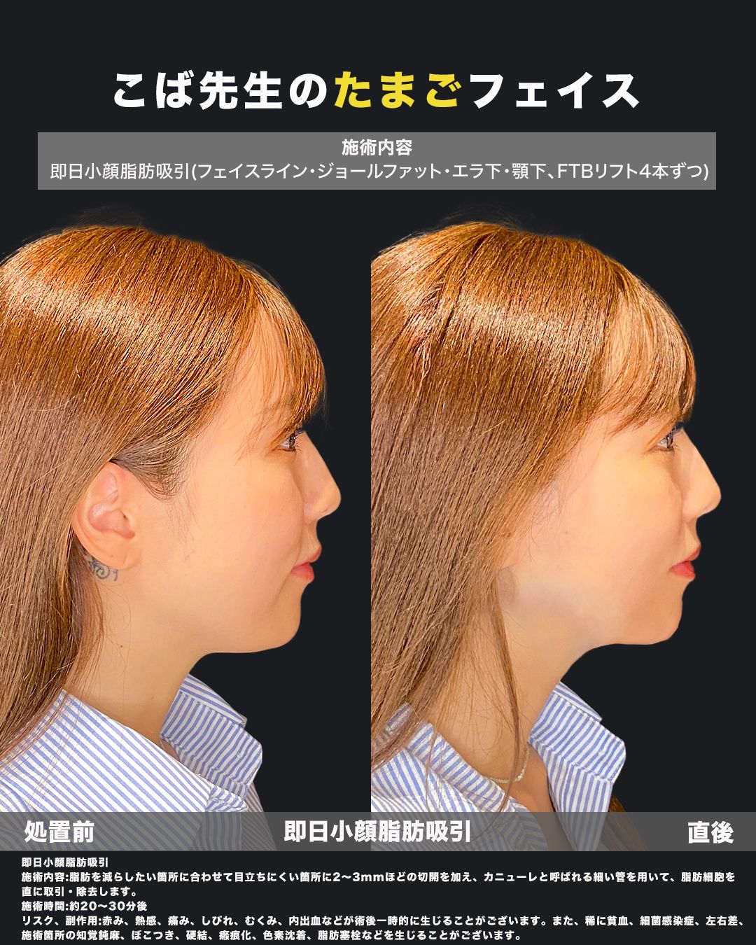 脂肪吸引症例写真（横）