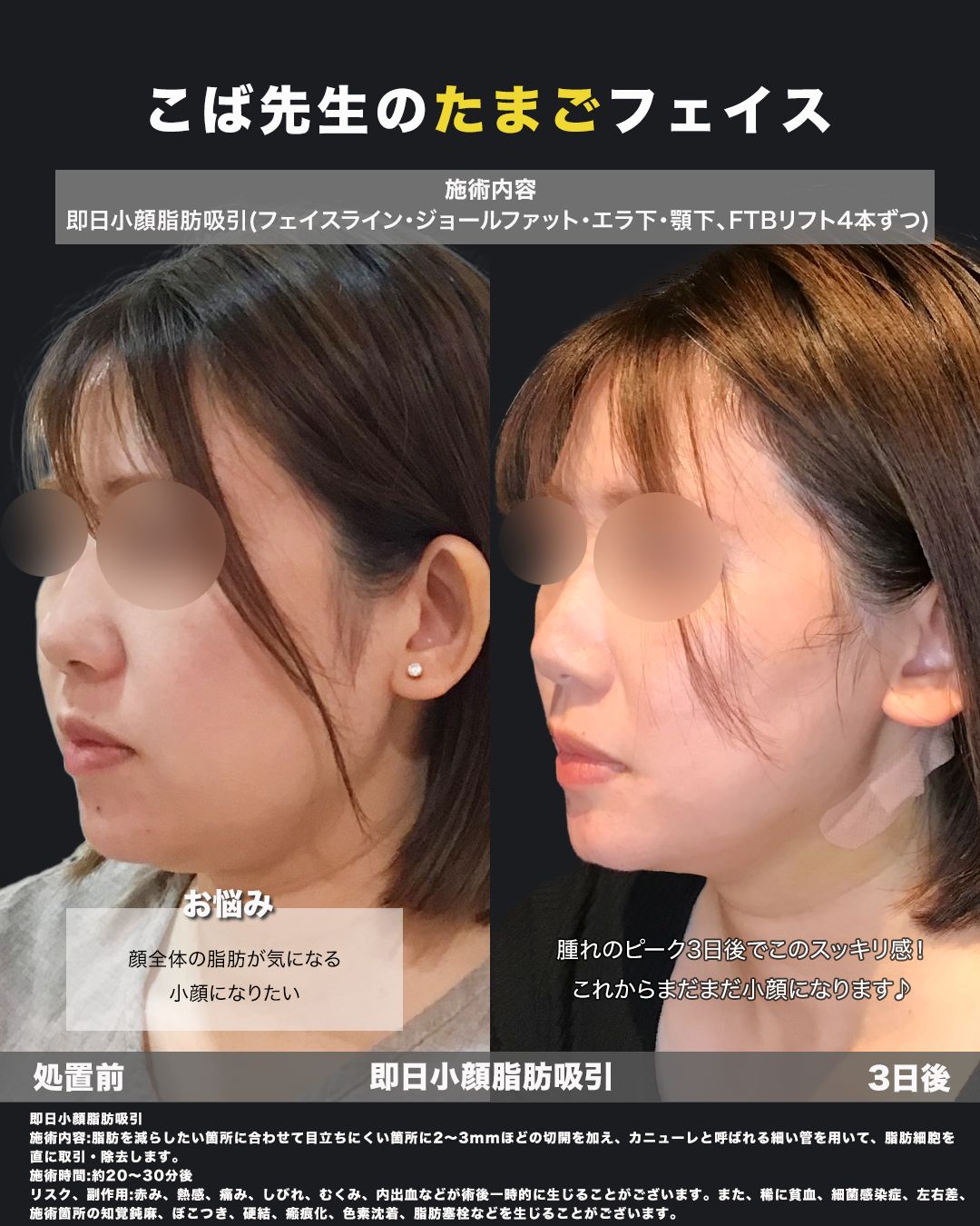 即日小顔脂肪吸引6（斜め）