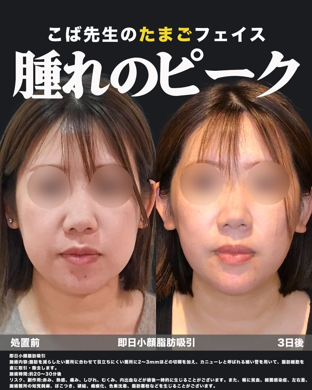 即日小顔脂肪吸引6（正面）