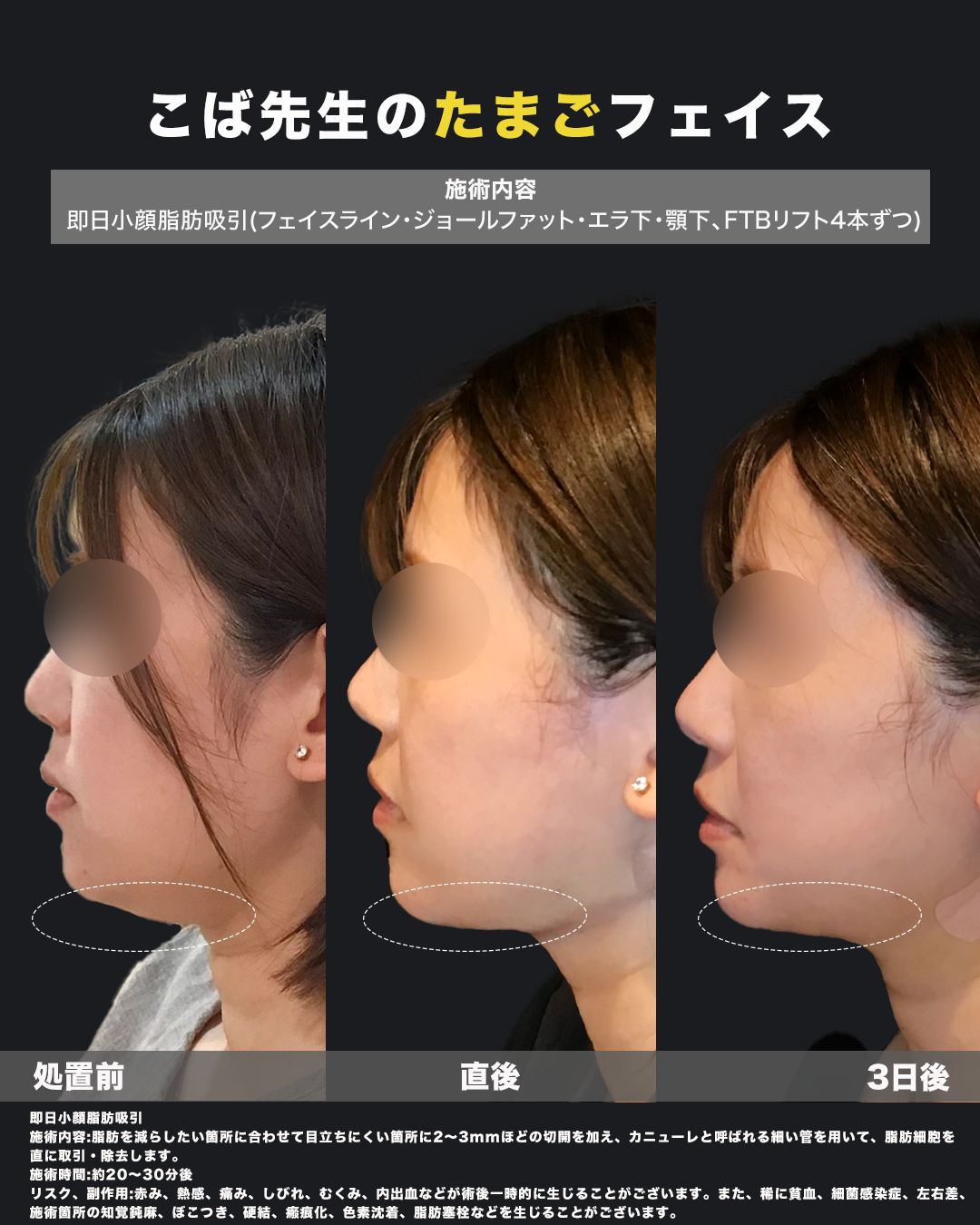 即日小顔脂肪吸引6（横）