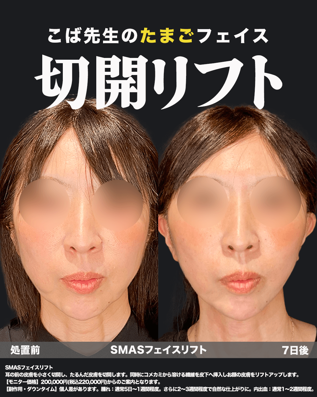 切開リフト症例写真4（正面）