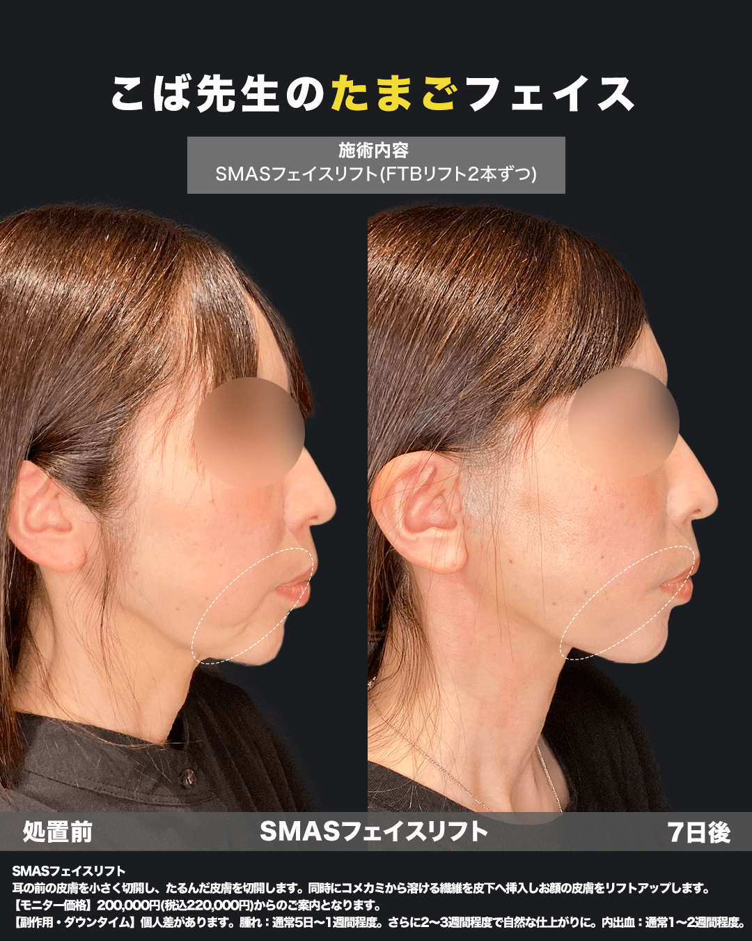 切開リフト症例写真4（横）