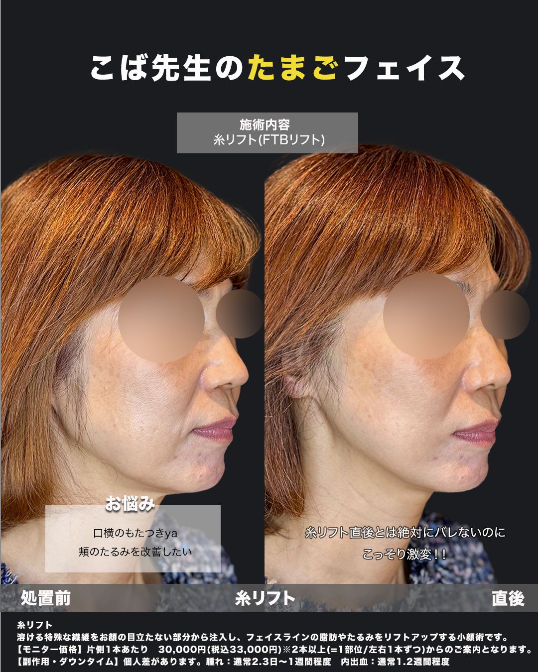 糸リフト症例20番（斜め）