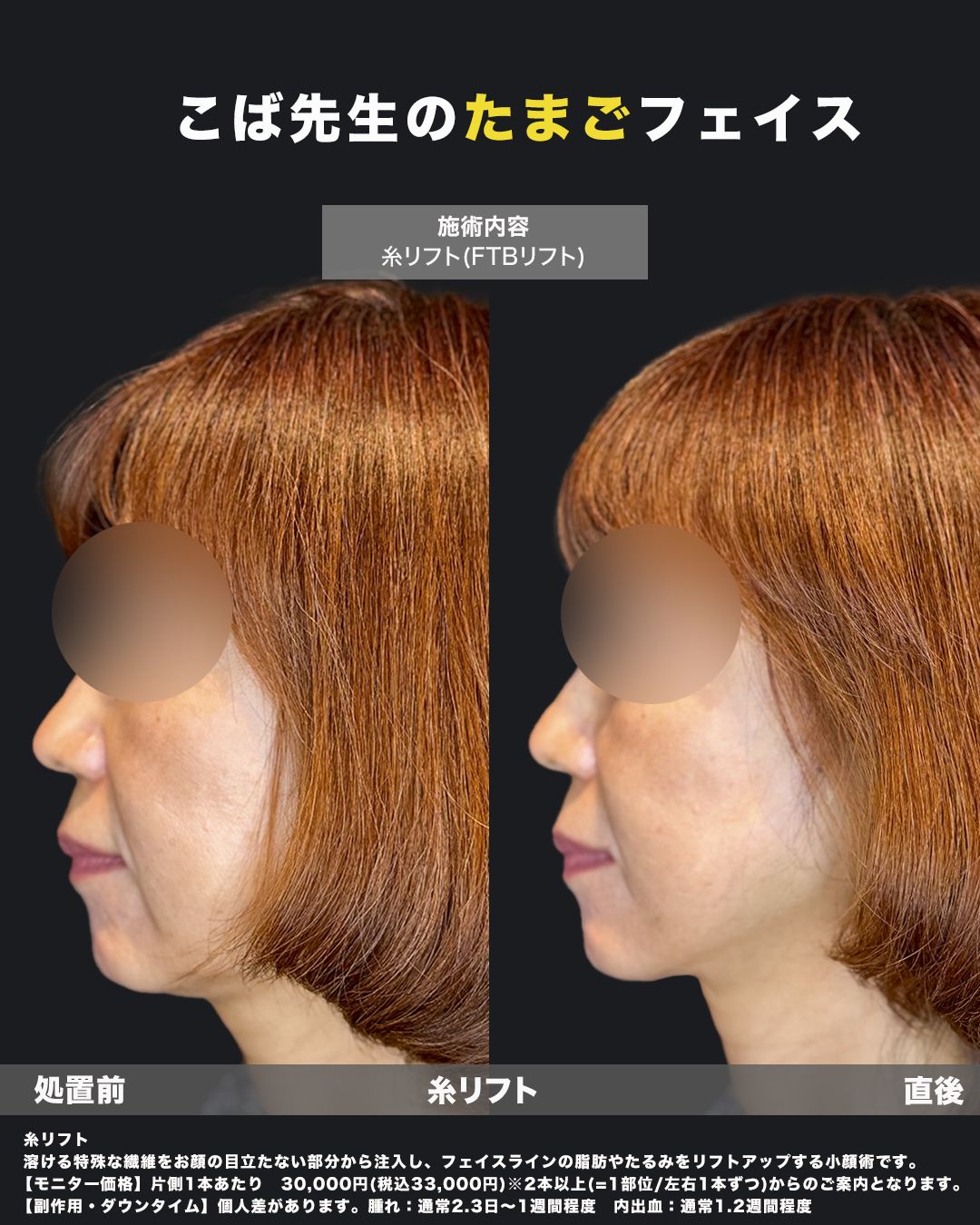 糸リフト症例20番（横）