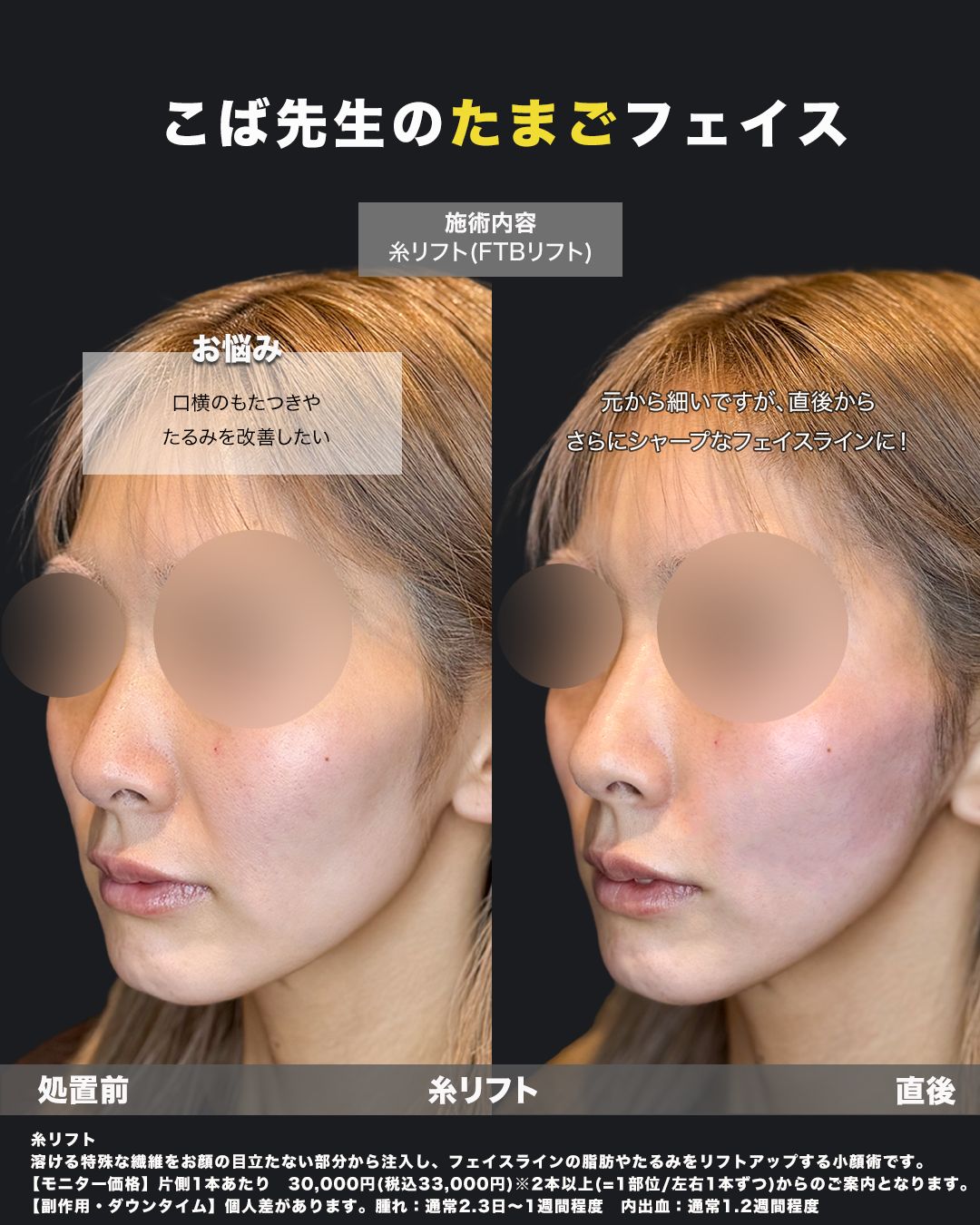 糸リフト症例写真21（斜め）