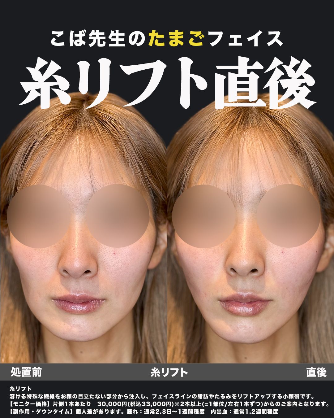 糸リフト症例写真21（正面）