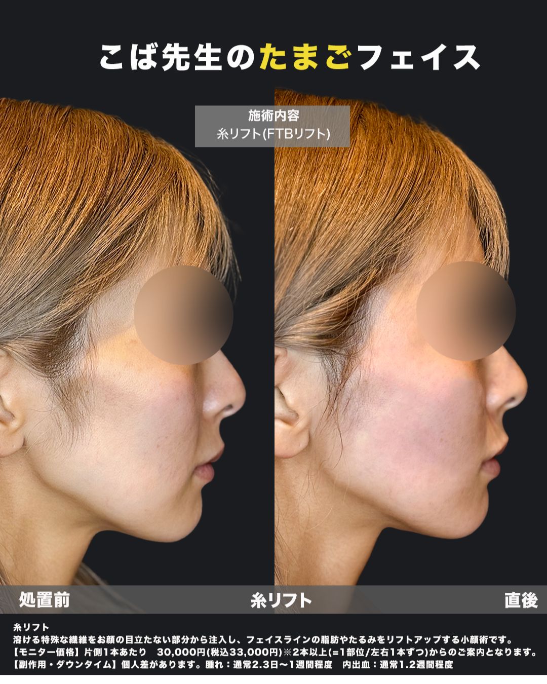 糸リフト症例写真21（横）