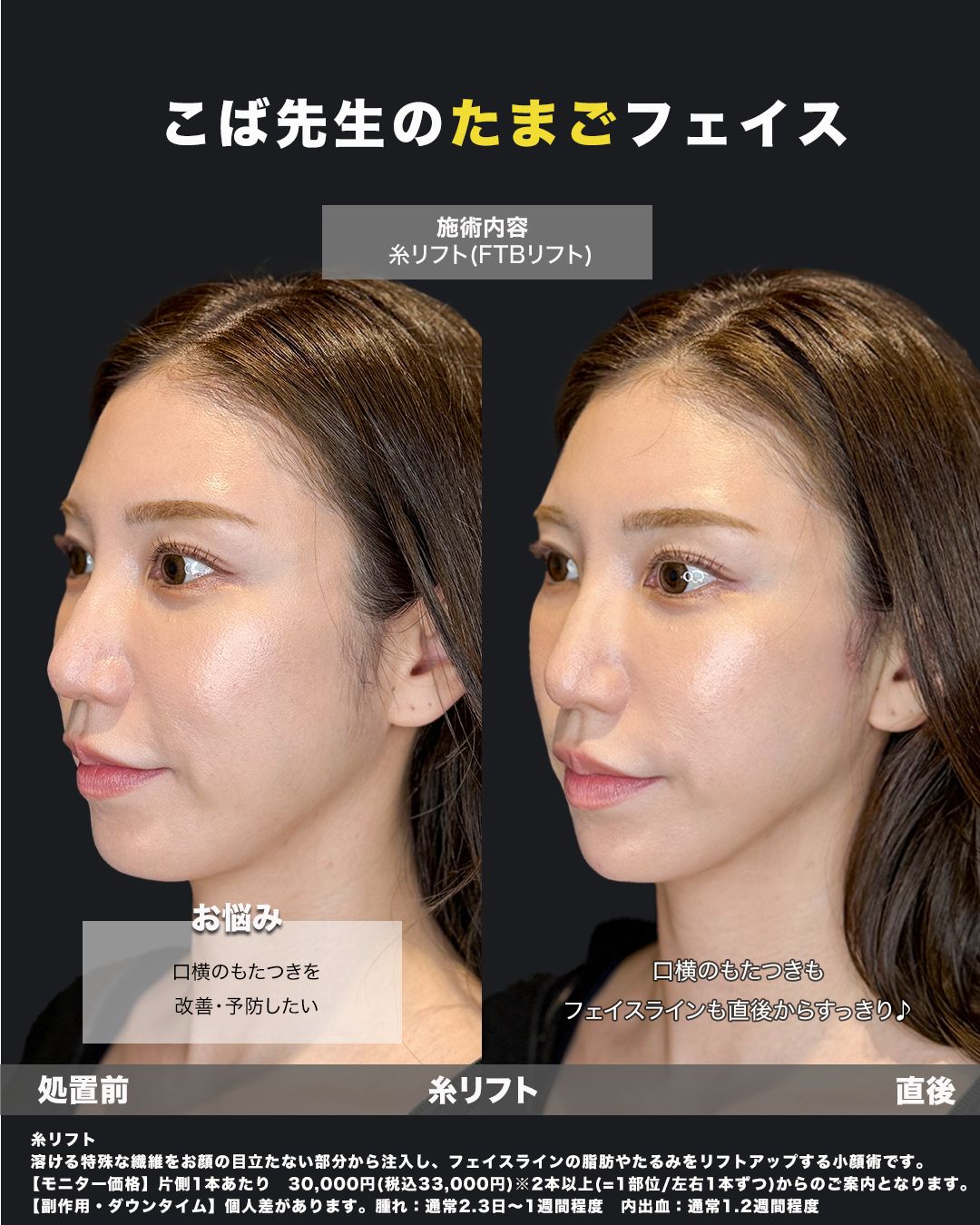 糸リフト直後（斜め）症例16