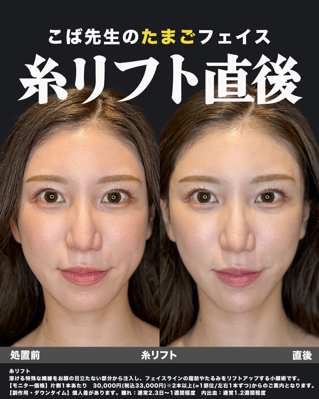 糸リフト直後（正面）症例16