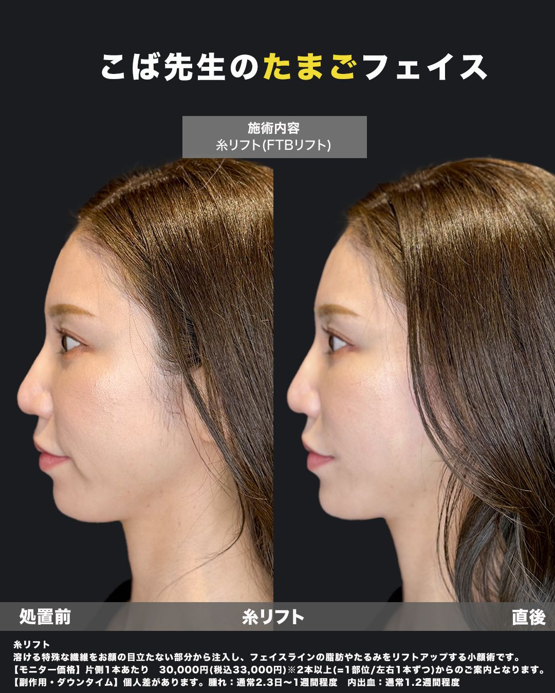 糸リフト直後（横）症例16