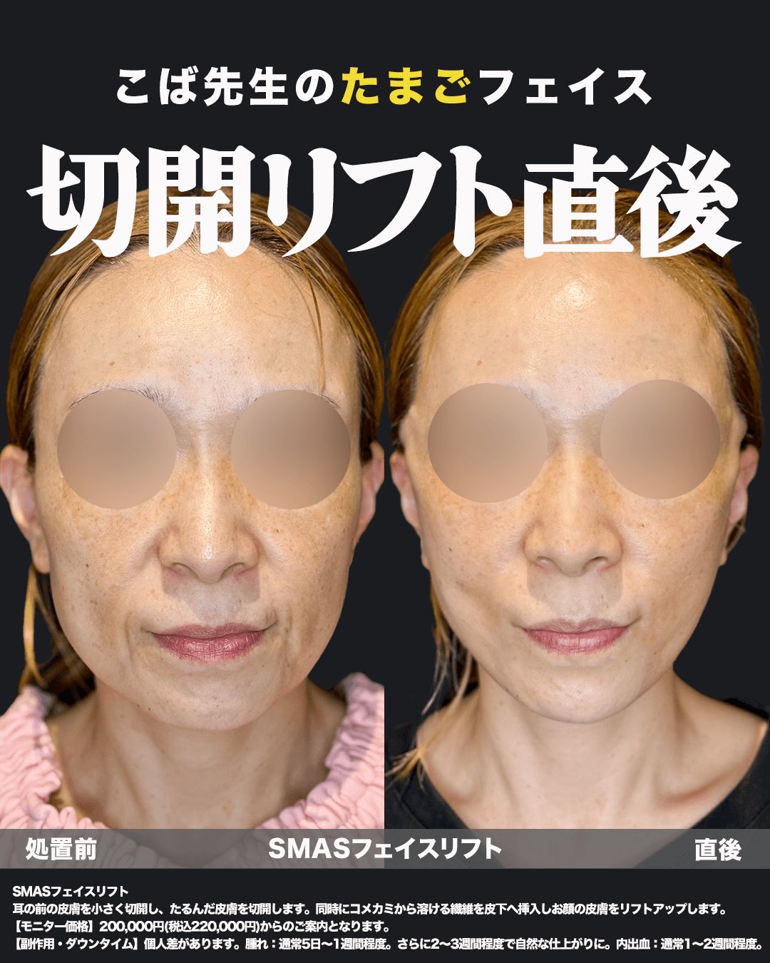 切開リフト直後の症例写真14（正面）
