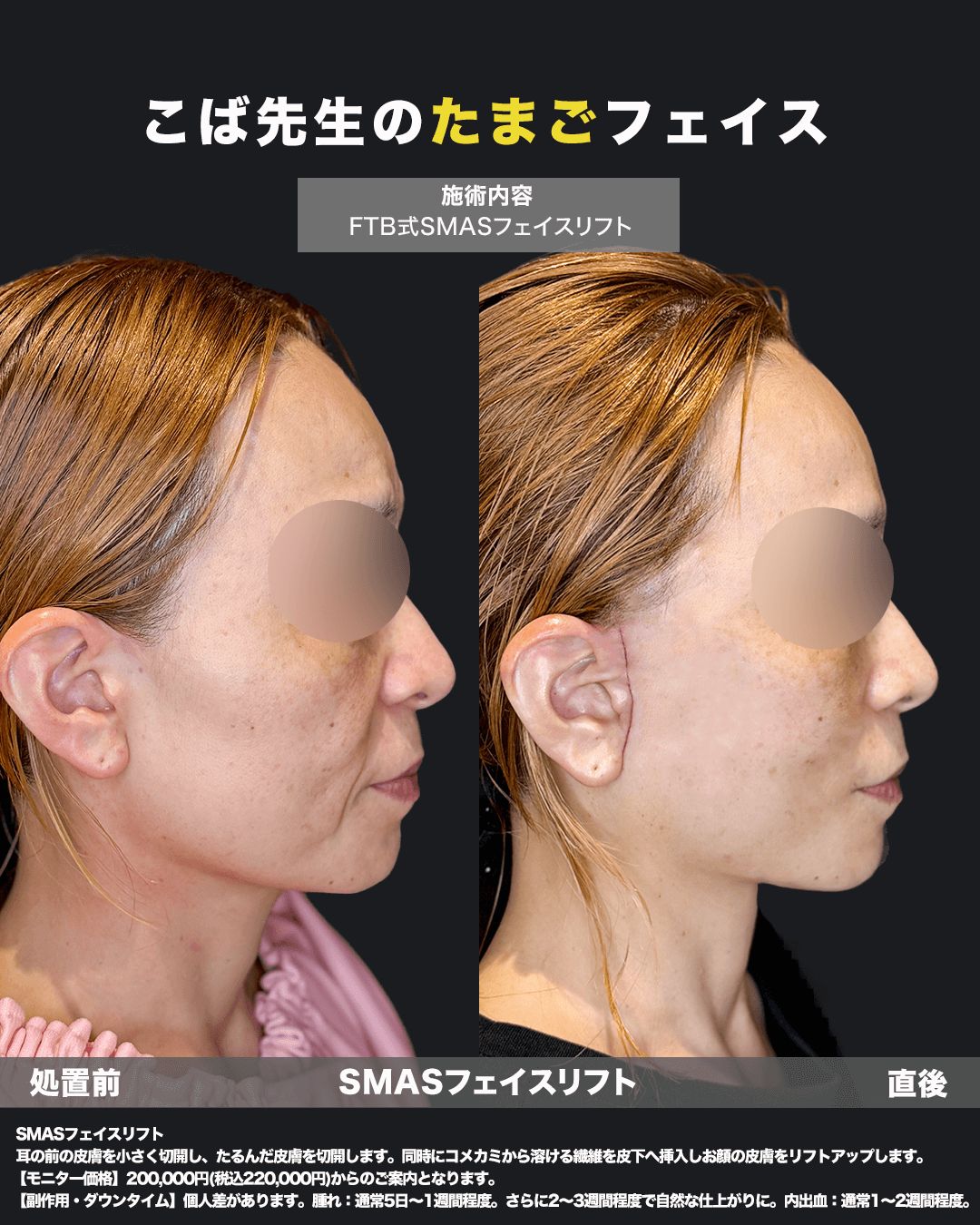 切開リフト直後の症例写真14（横）