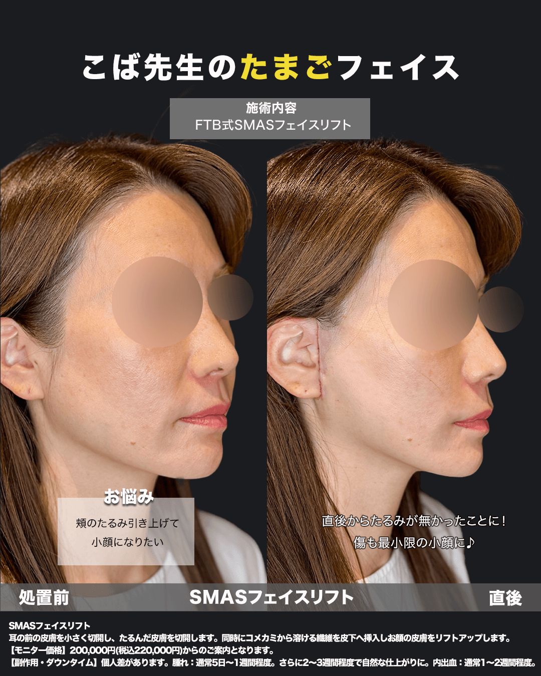 切開リフト直後の症例写真16（斜め）