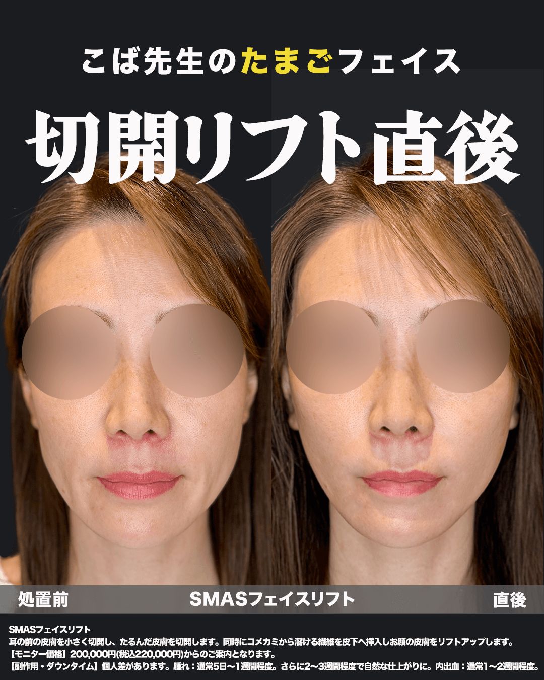 切開リフト直後の症例写真16（正面）