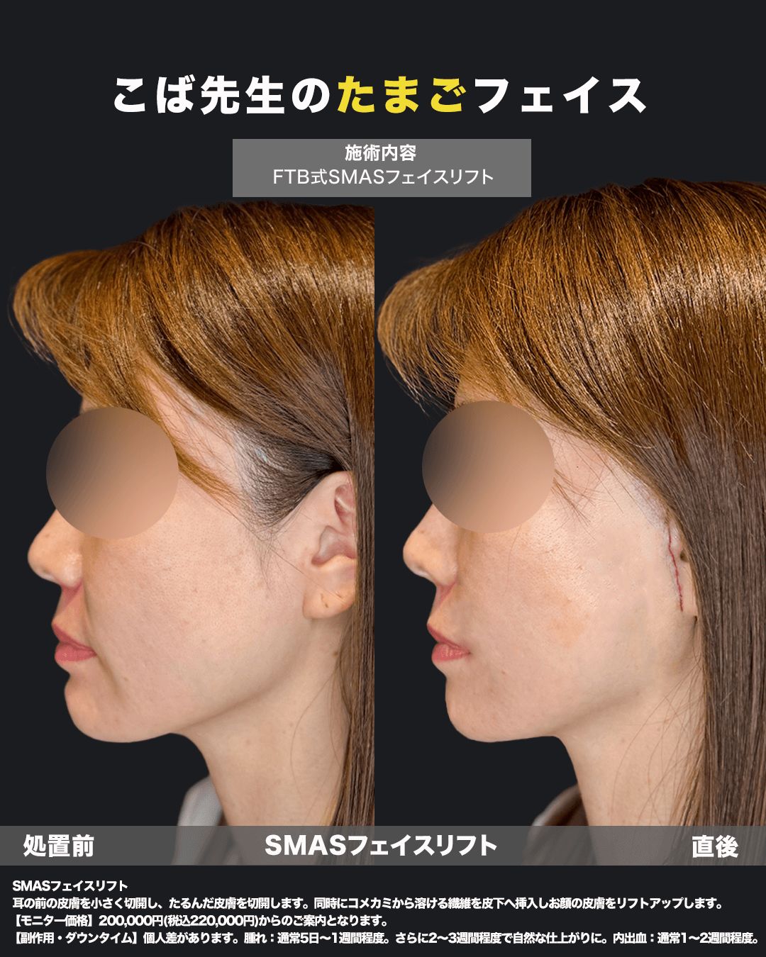 切開リフト直後の症例写真16（横）