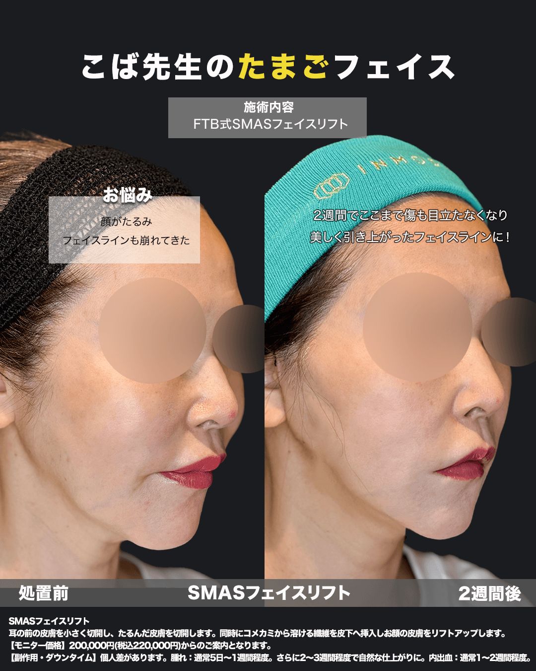 切開リフトの症例写真17（斜め）