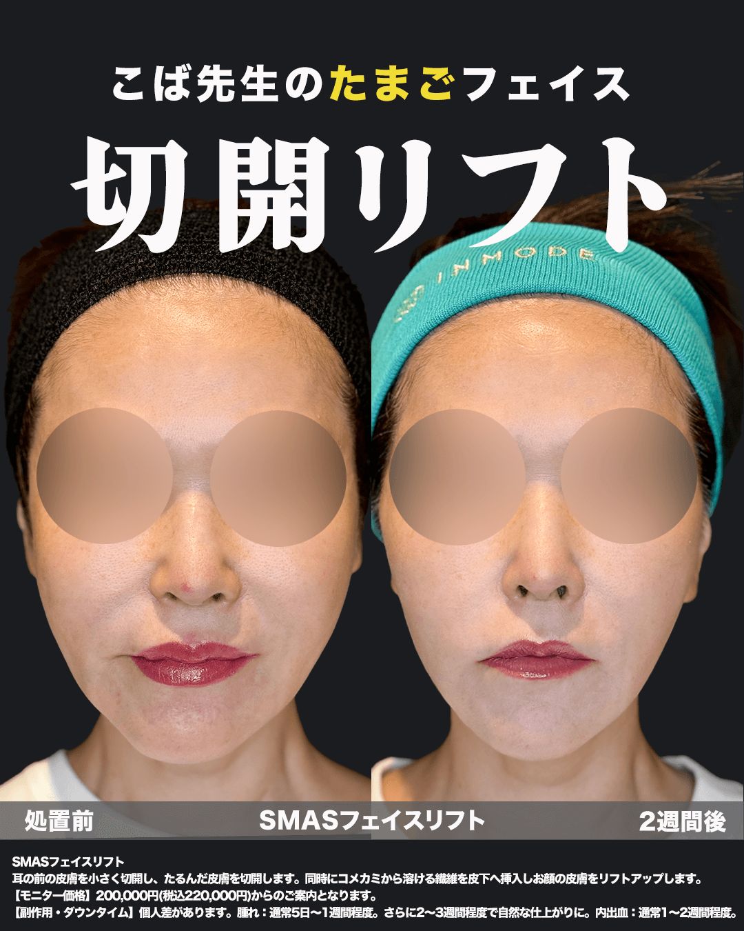 切開リフトの症例写真17（正面）