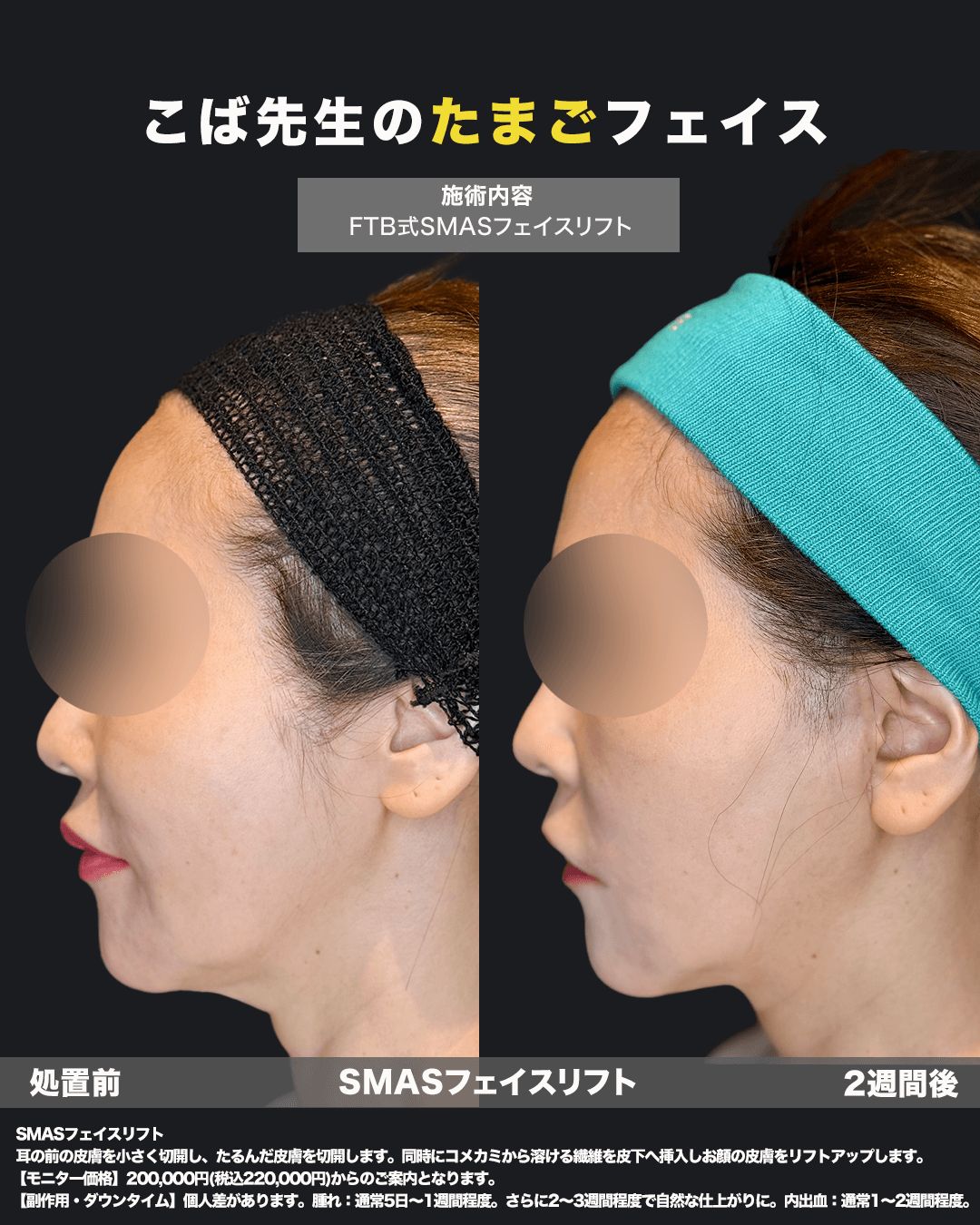 切開リフトの症例写真17（横）