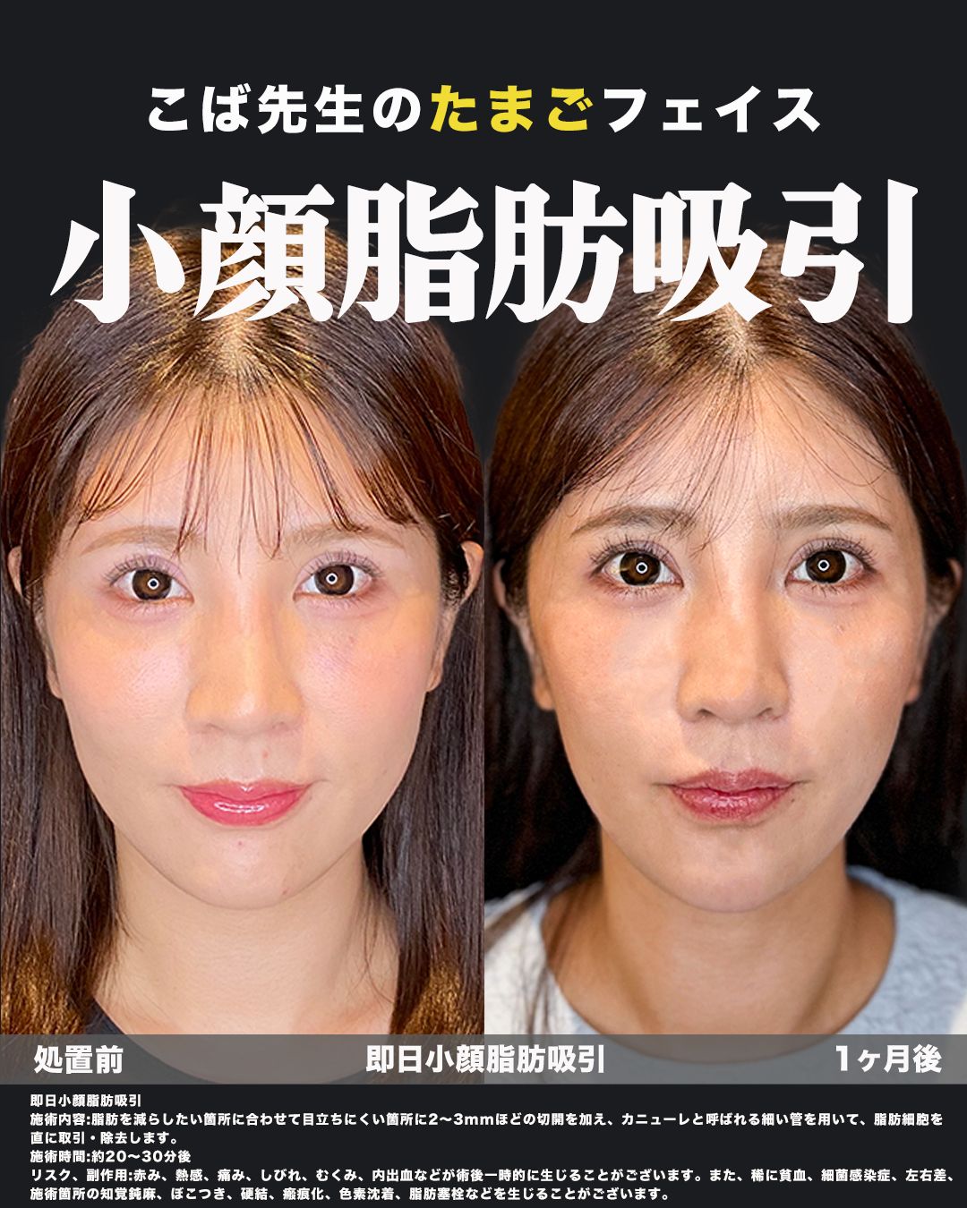 小顔脂肪吸引-症例30（正面）