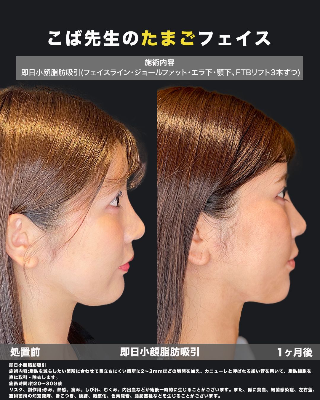 小顔脂肪吸引-症例30（横）