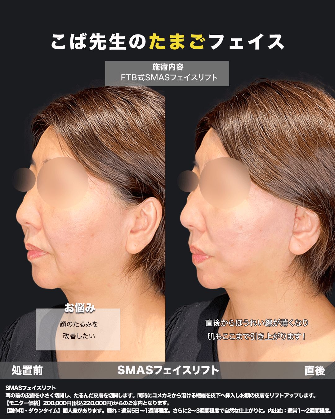 切開リフト症例11（斜め）