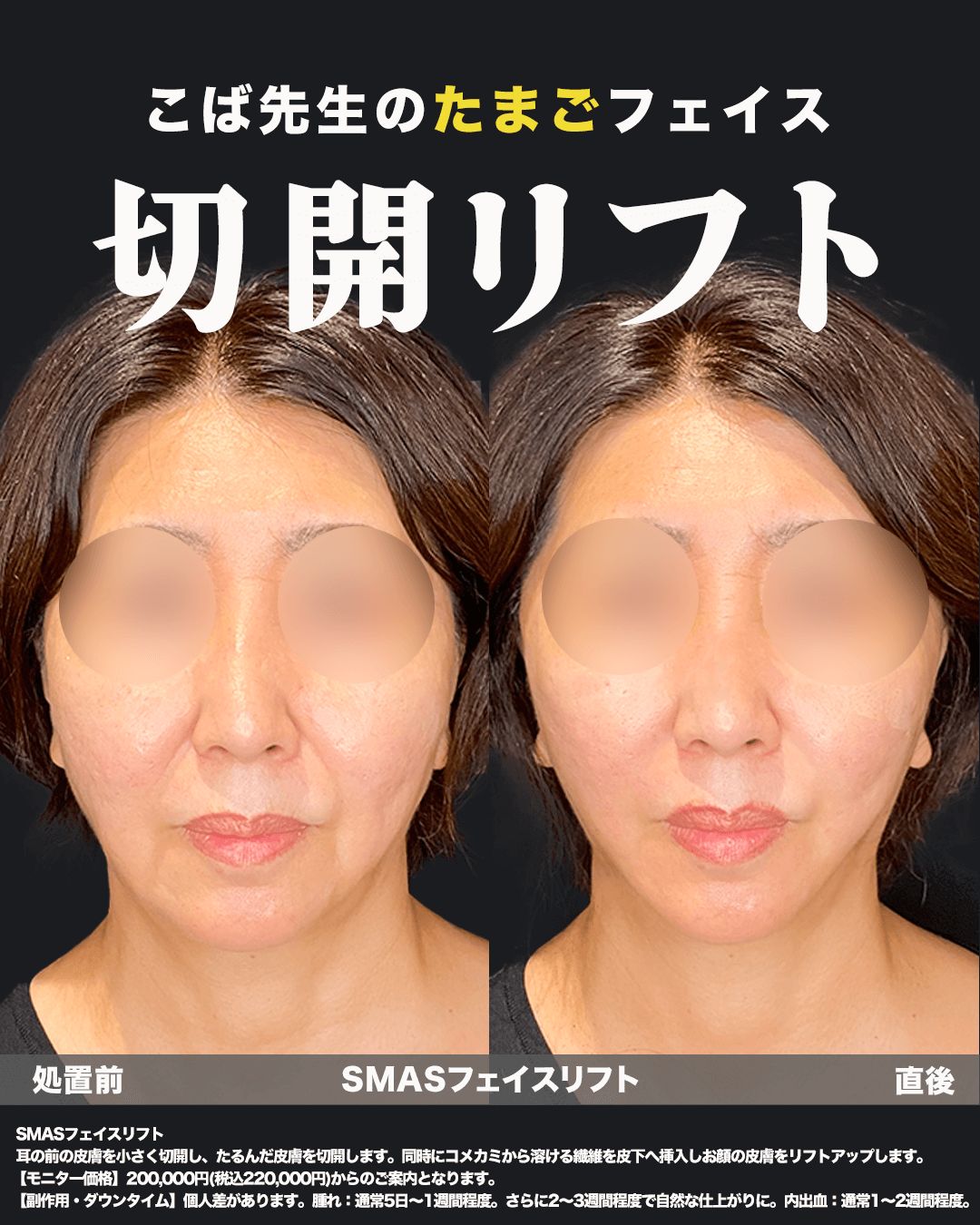 切開リフト症例11（正面）