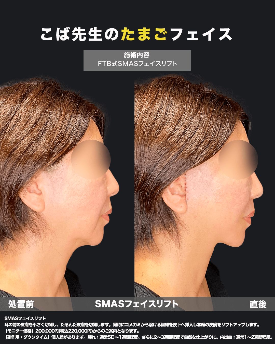 切開リフト症例11（横）