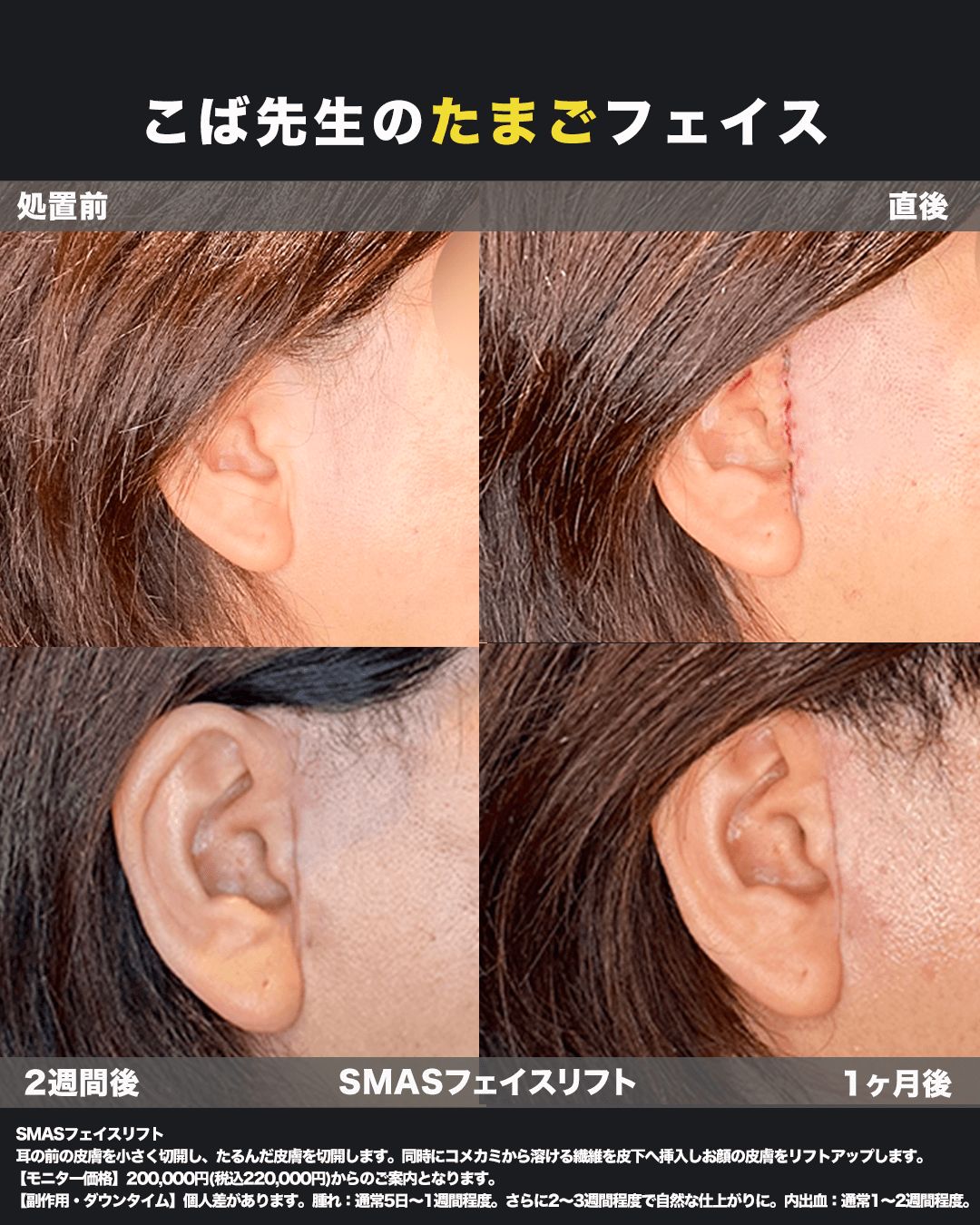 切開リフト症例11（傷跡）