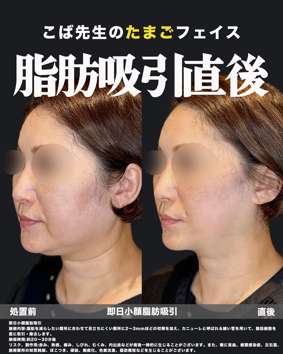 脂肪吸引症例写真39（斜め）