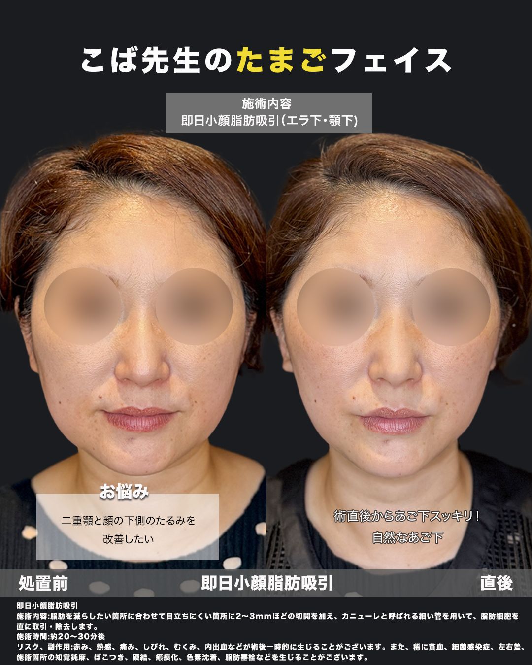 脂肪吸引症例写真39（正面）