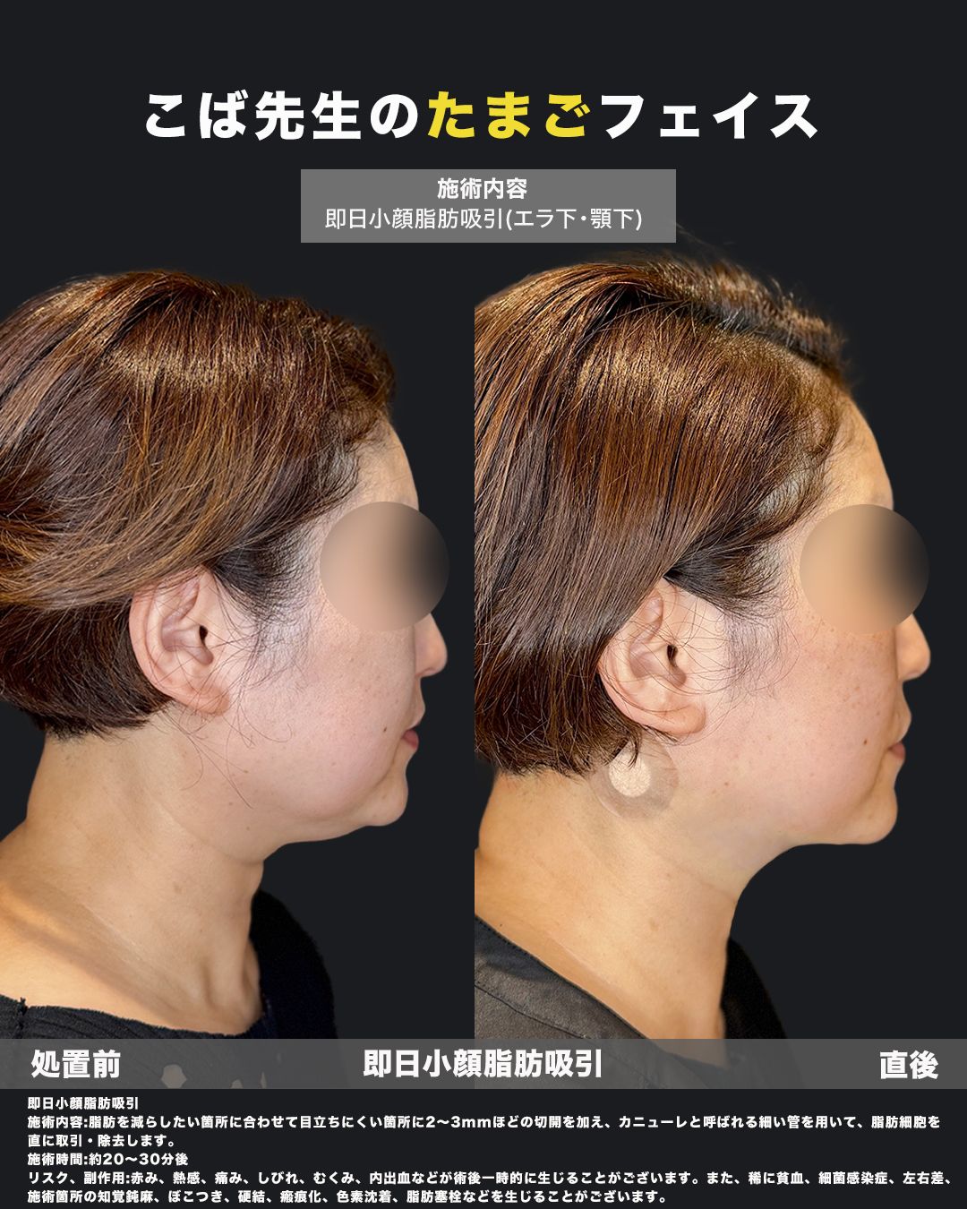 脂肪吸引症例写真39（横）